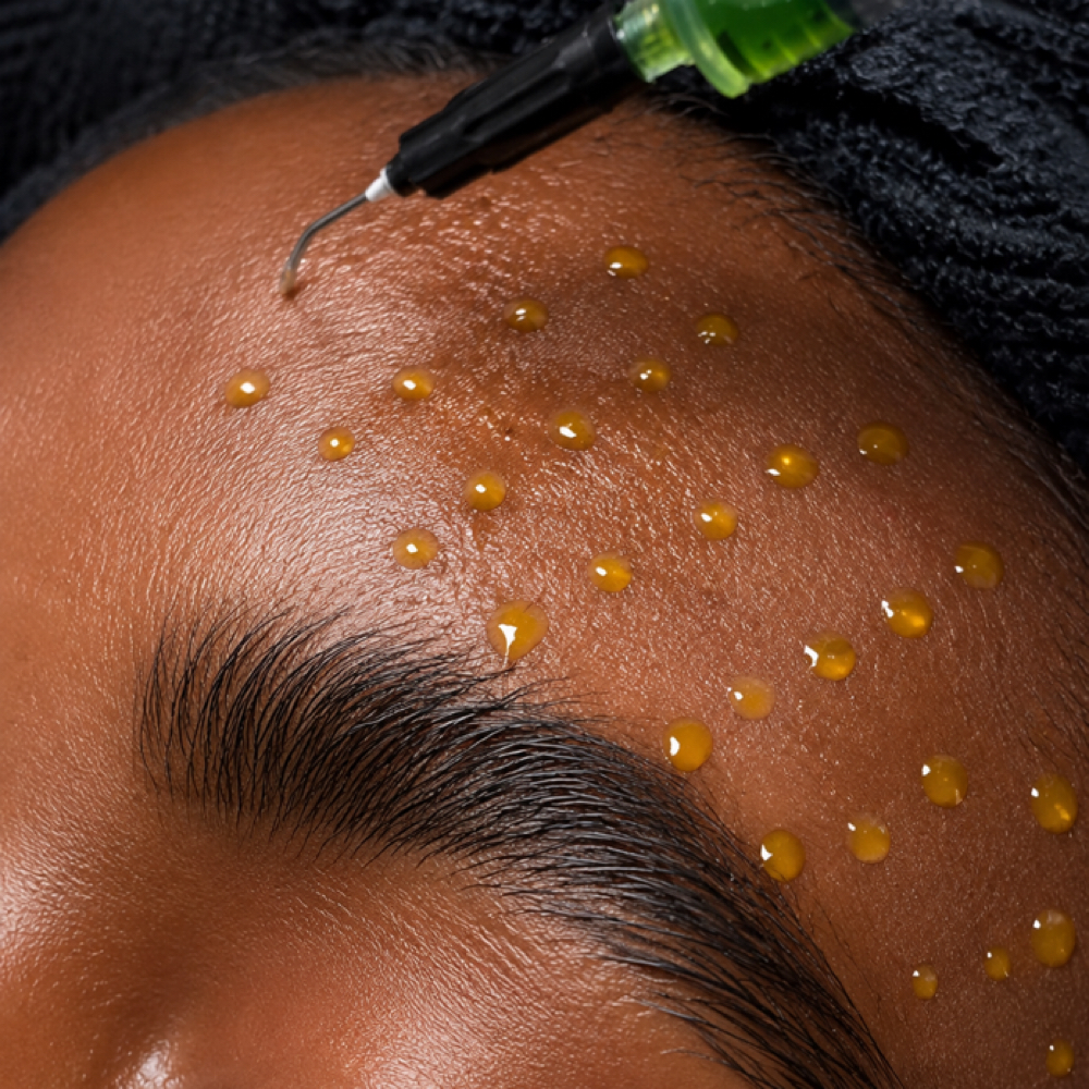 BIOREPEEL at Esther Esthetics in Suwanee, GA