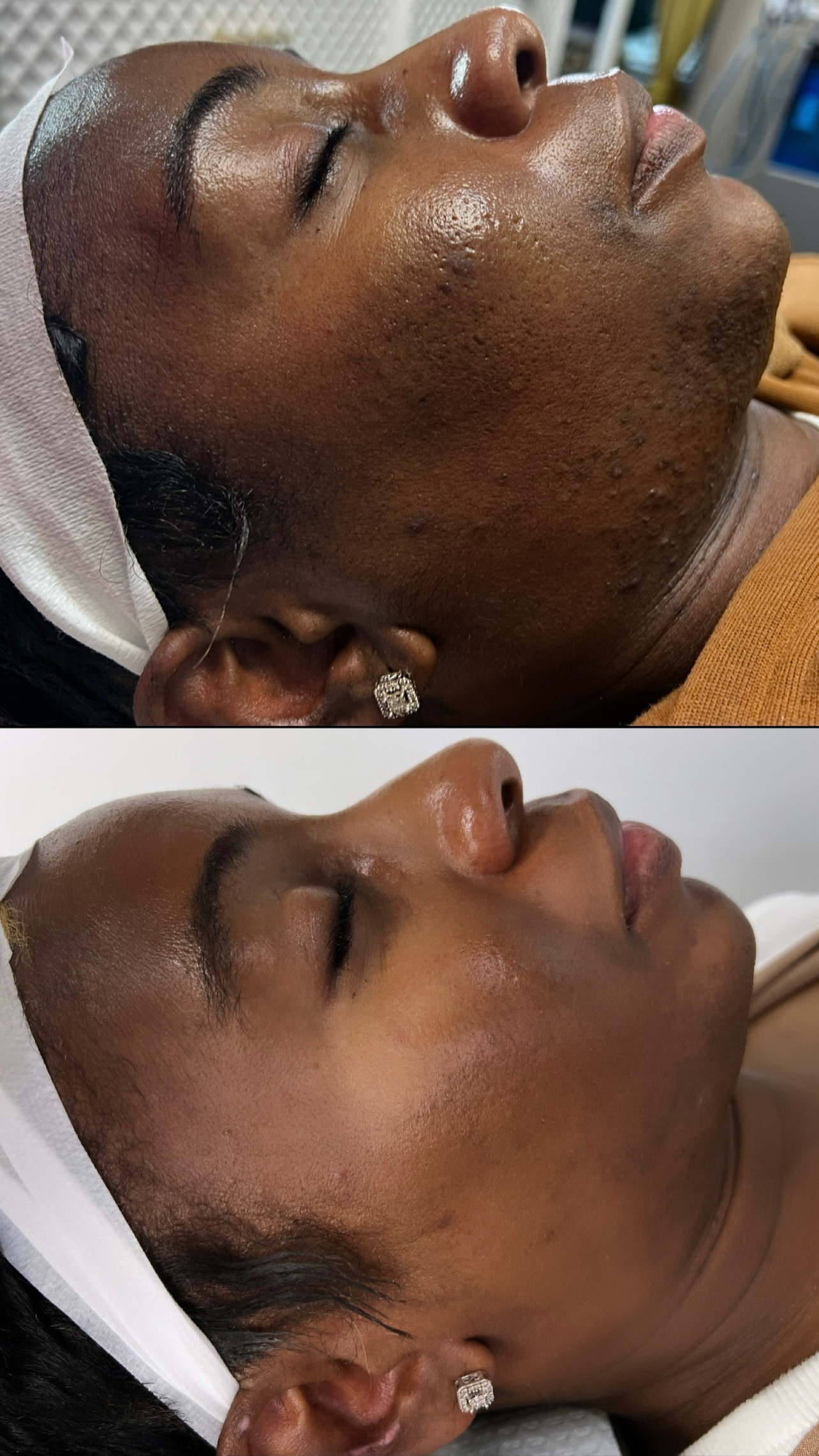 MICRONEEDLING w/ SERUM at FIRMÉ SKIN in Columbia, MD
