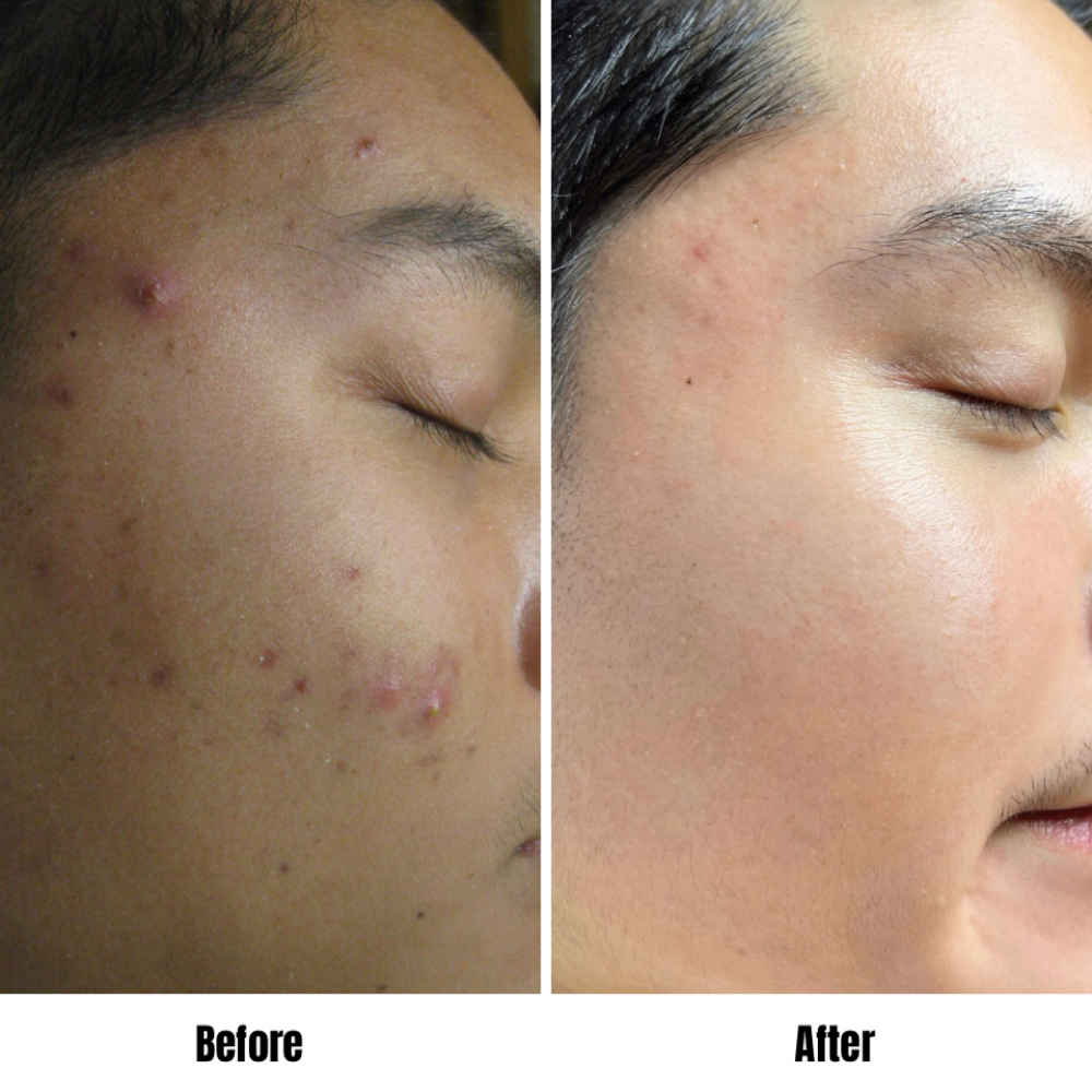 Bi-Weekly Acne Facial at Good Skin Co. in Sarasota, FL