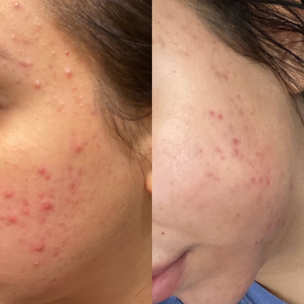 Acne Facial