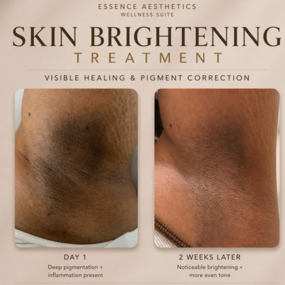 Skin Brightening Treatments at Essence Aesthetics Wellness Suite LLC in Troy, NY