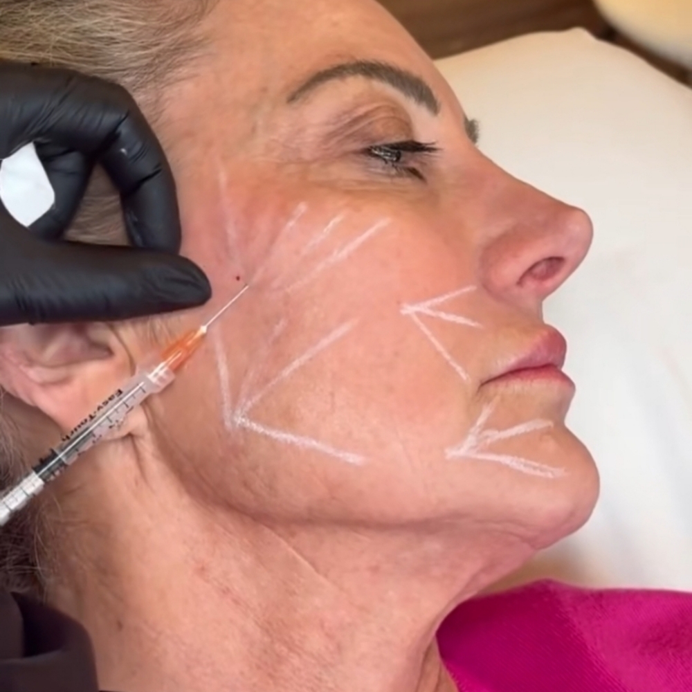 Sculptra® Biostimulator at D'Yalorde Wellness & Aesthetics LLC in El Paso, TX