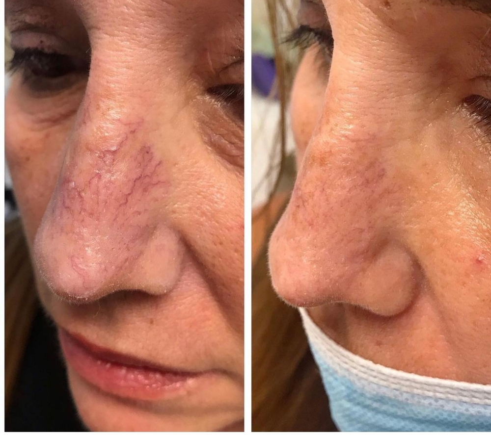 IPL VASCULAR & Vein Treatment