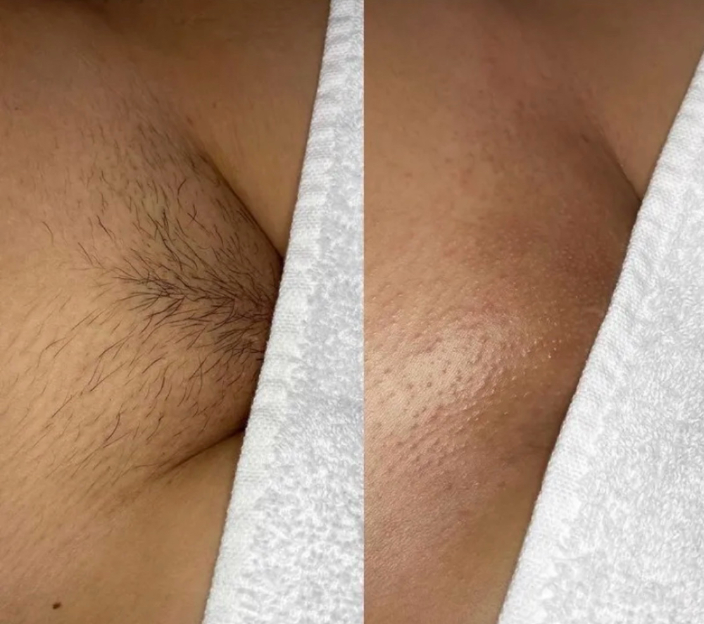 Brazilian Wax