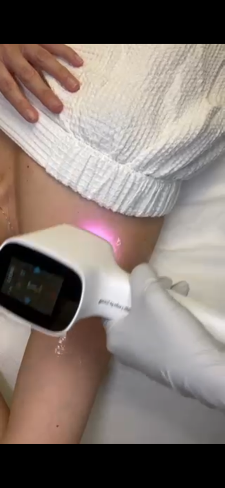 Laser Hair Removal  -  Medium Areas
