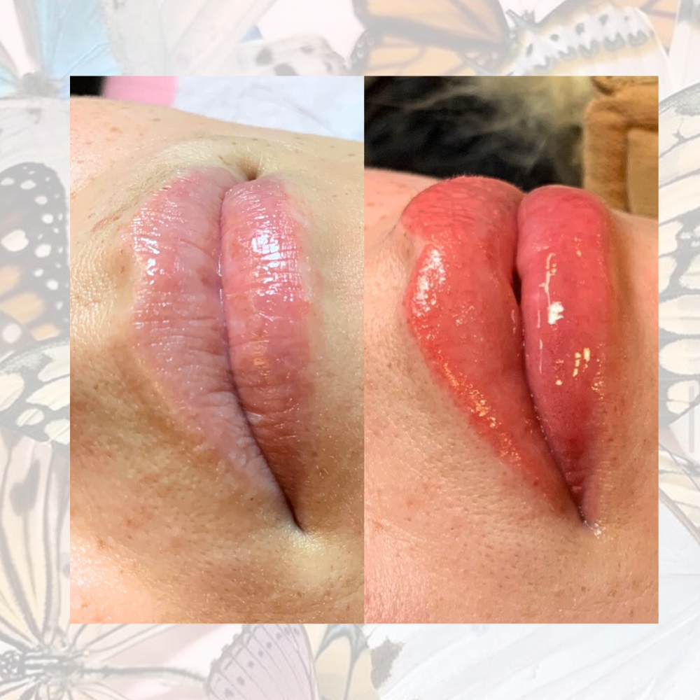 Lip Consultation at Manifest Management LLC in Spokane, WA