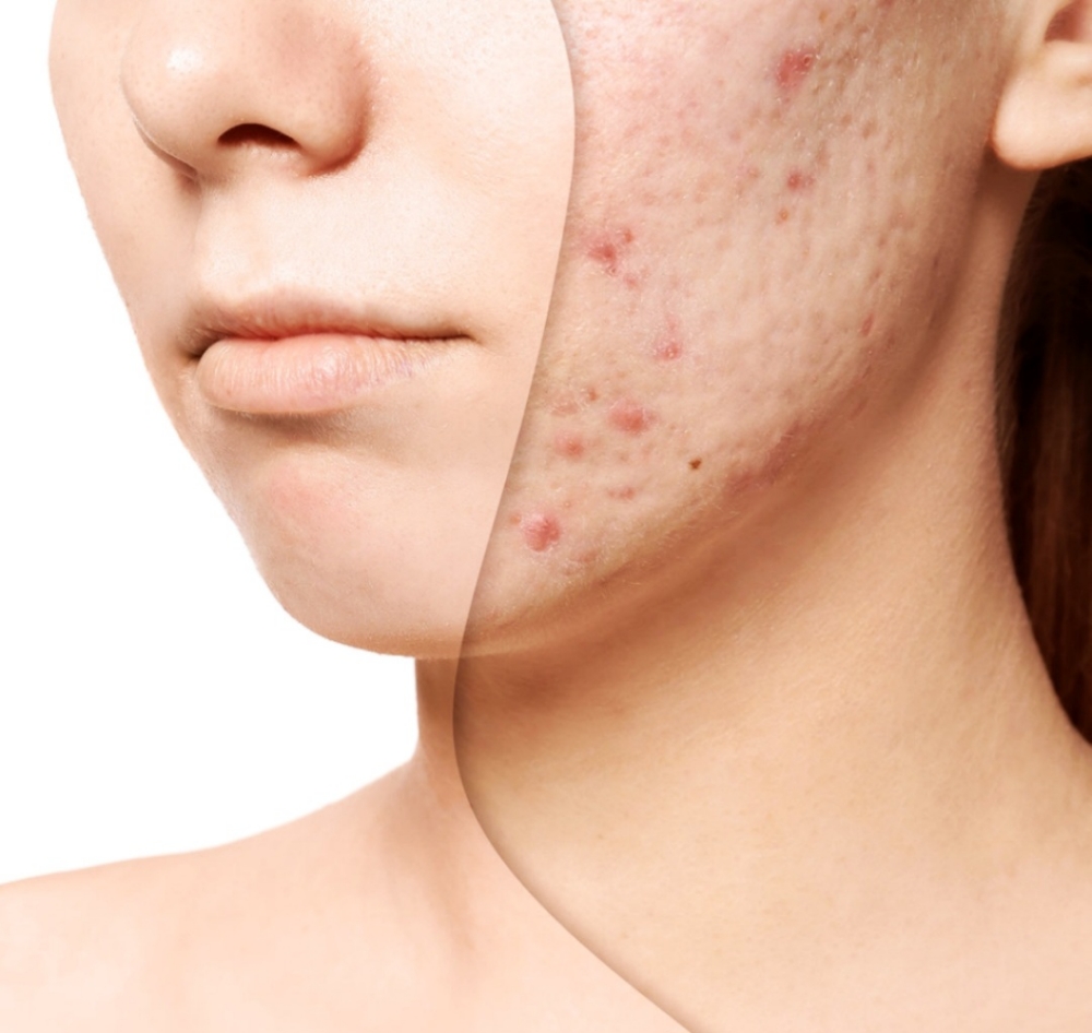 Acne Facial at Soluna Studio /Beauty & Wellness in Forest Hills, NY