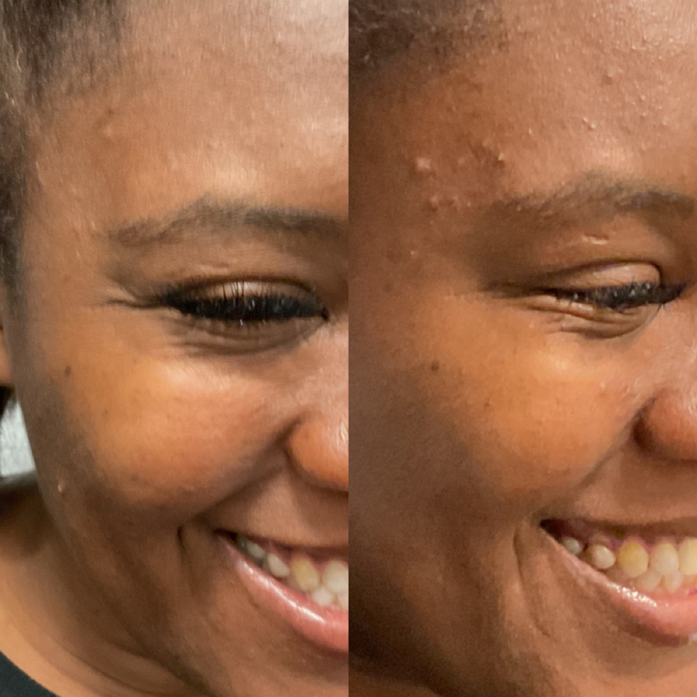Botox (Existing Client) at The Nice Needle and Spa in Prosper, TX