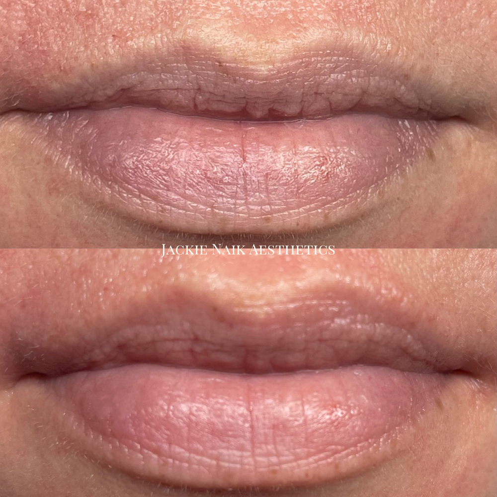 Hydrafacial Lip Perk Add-On