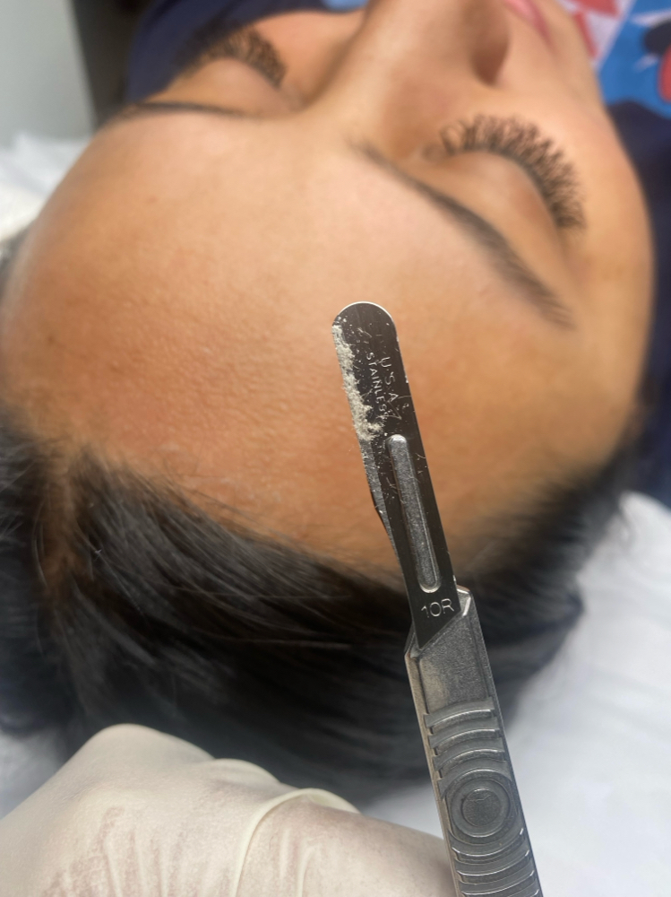 Express Dermaplaning
