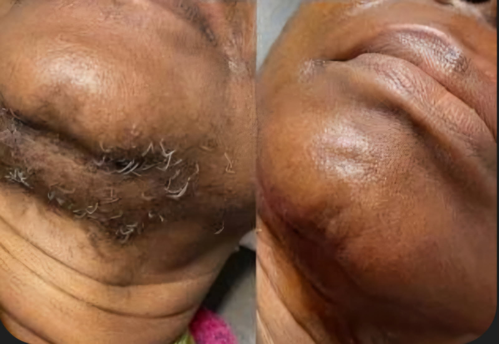 Chin Hair Removal