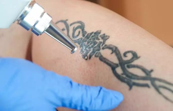 Tatto Removal Medium