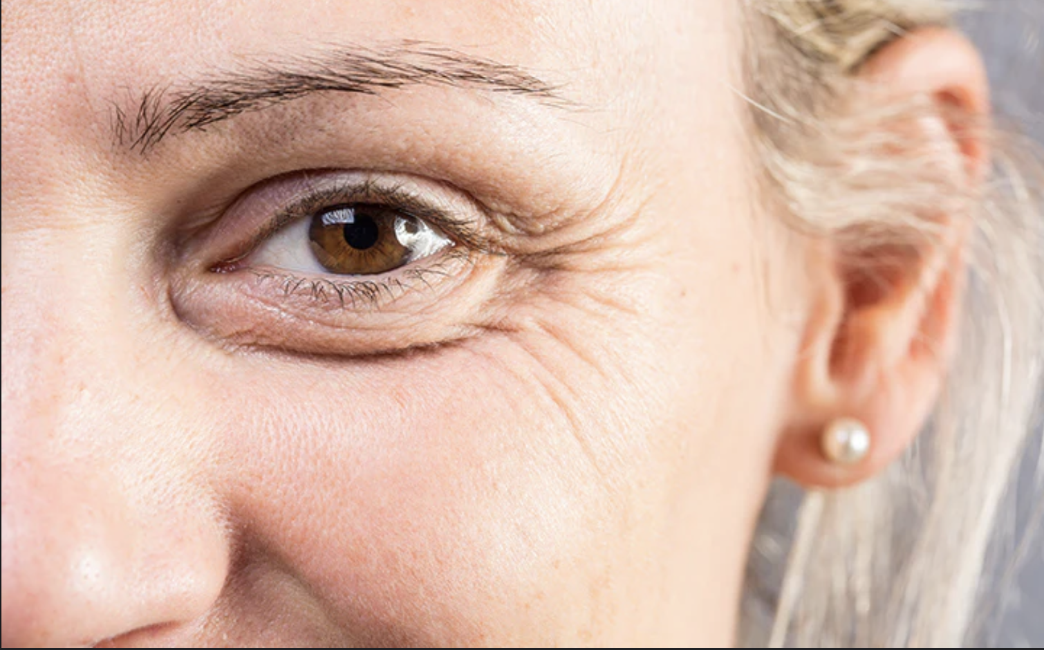 Crows Feet