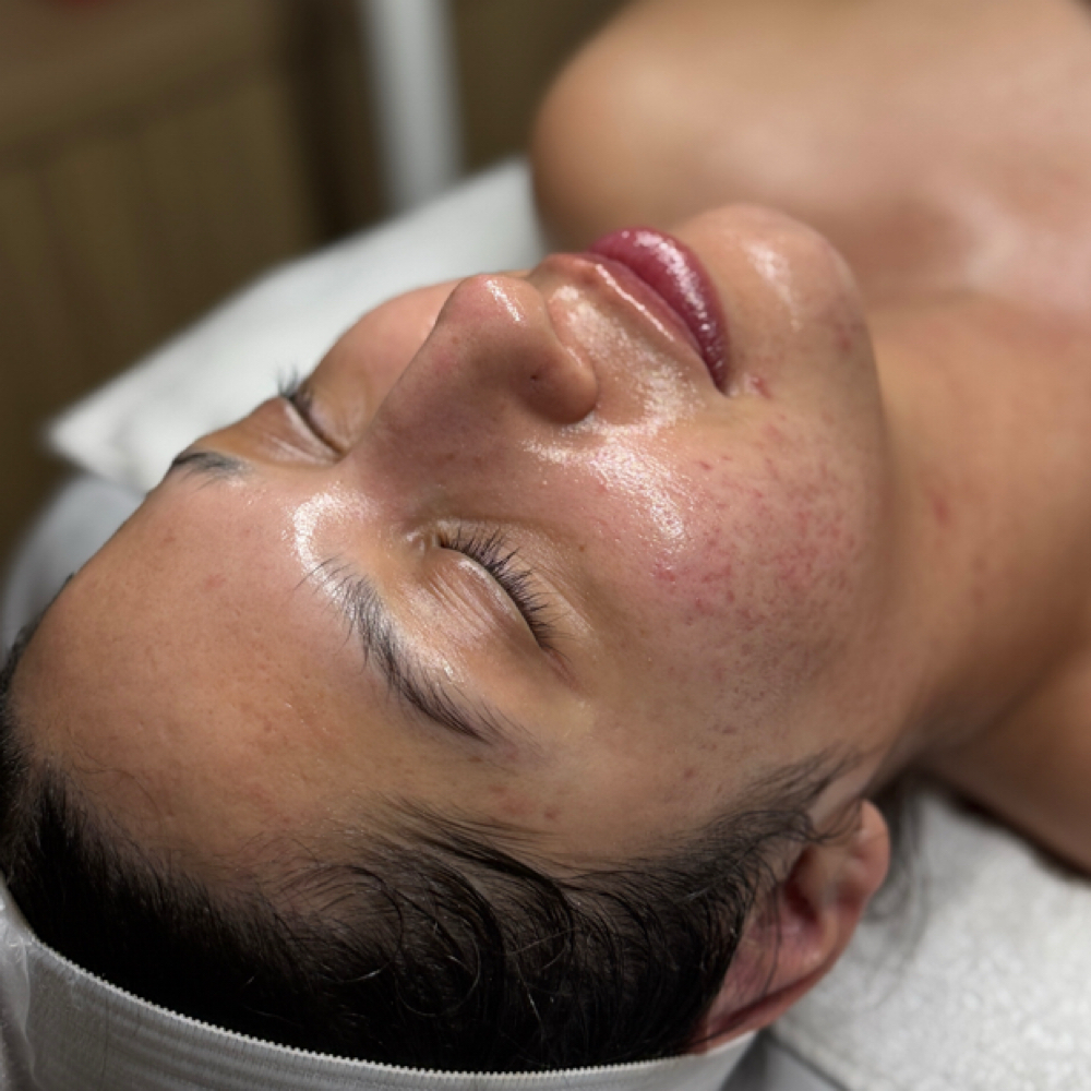 Microneedling Facial at Sesi Skin Therapy in Las Vegas, NV