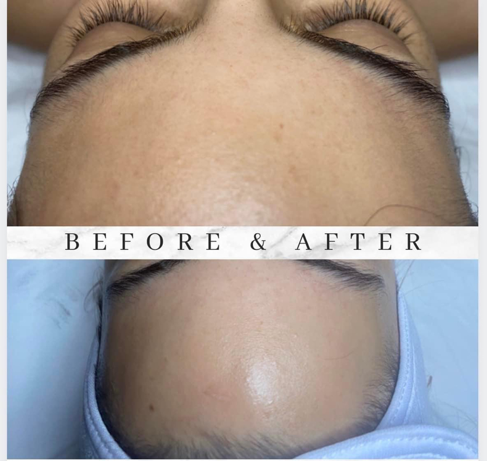Hydrafacial