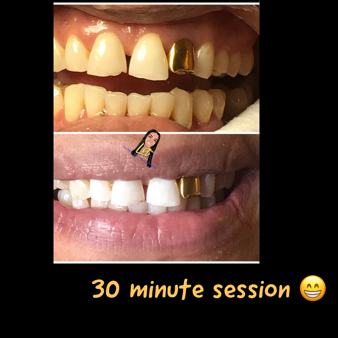 30 MIN TEETH WHITENING