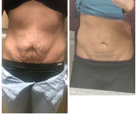 Body Contouring