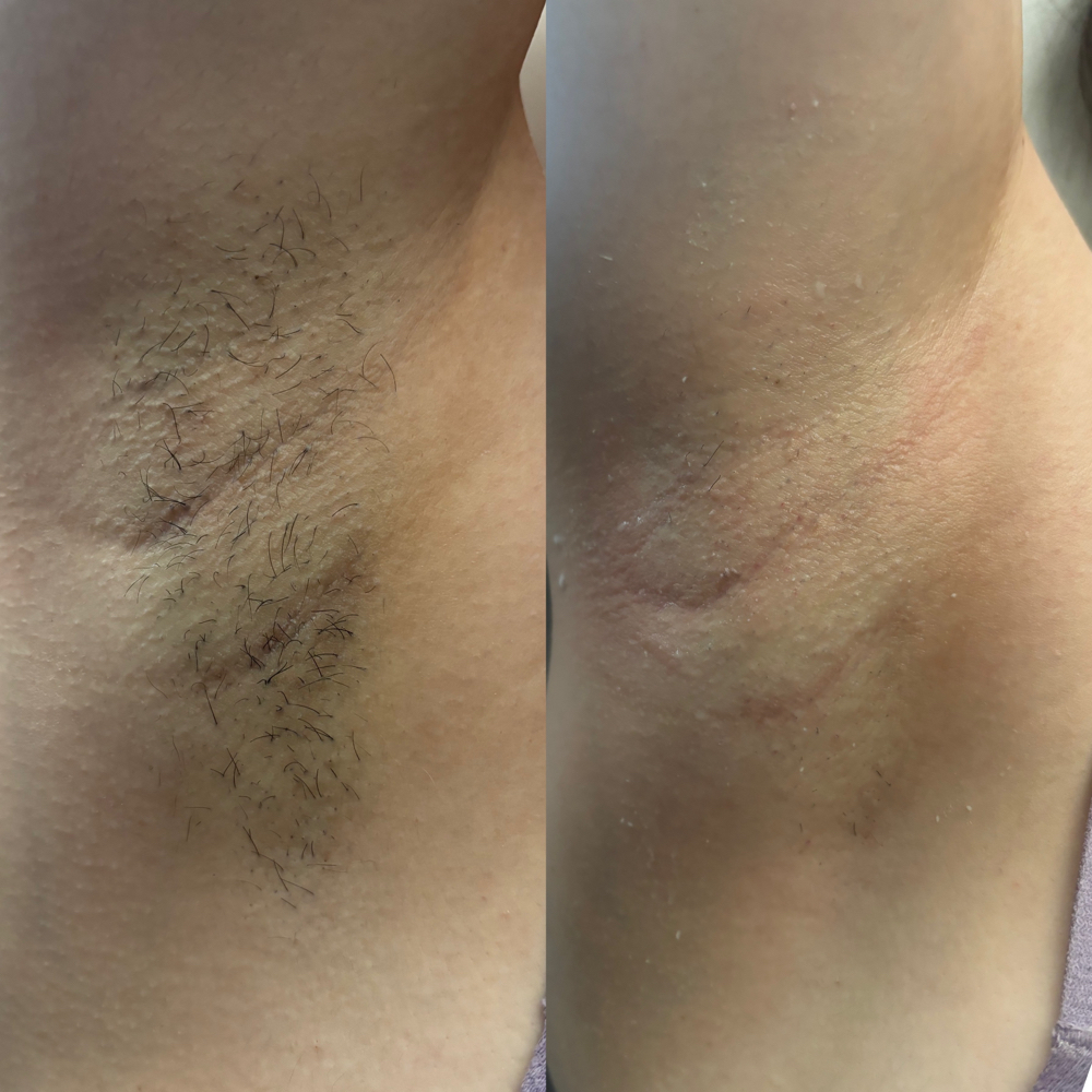Underarm Wax