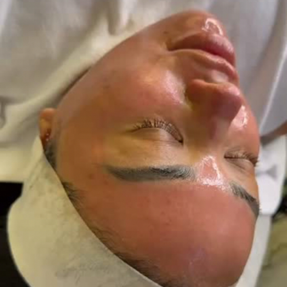 MICRONEEDLING at Aether Aesthetics in Midland, TX