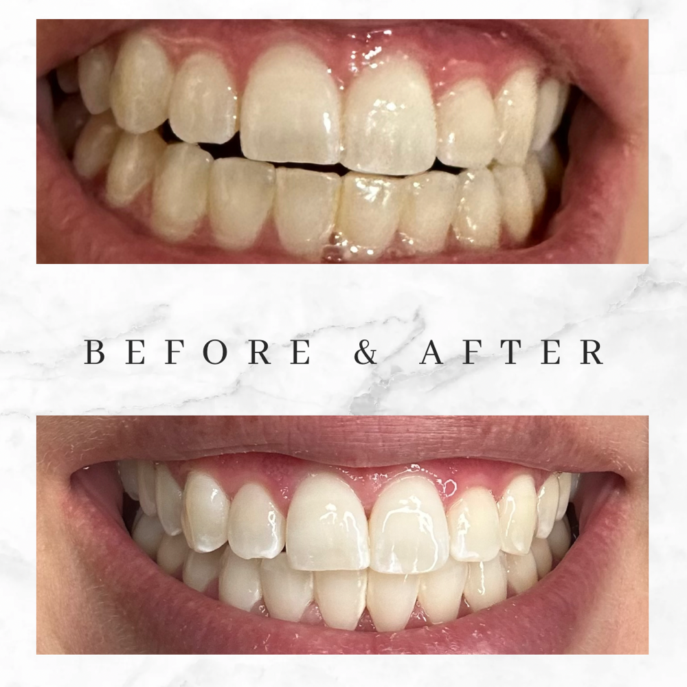 Express Teeth Whitening