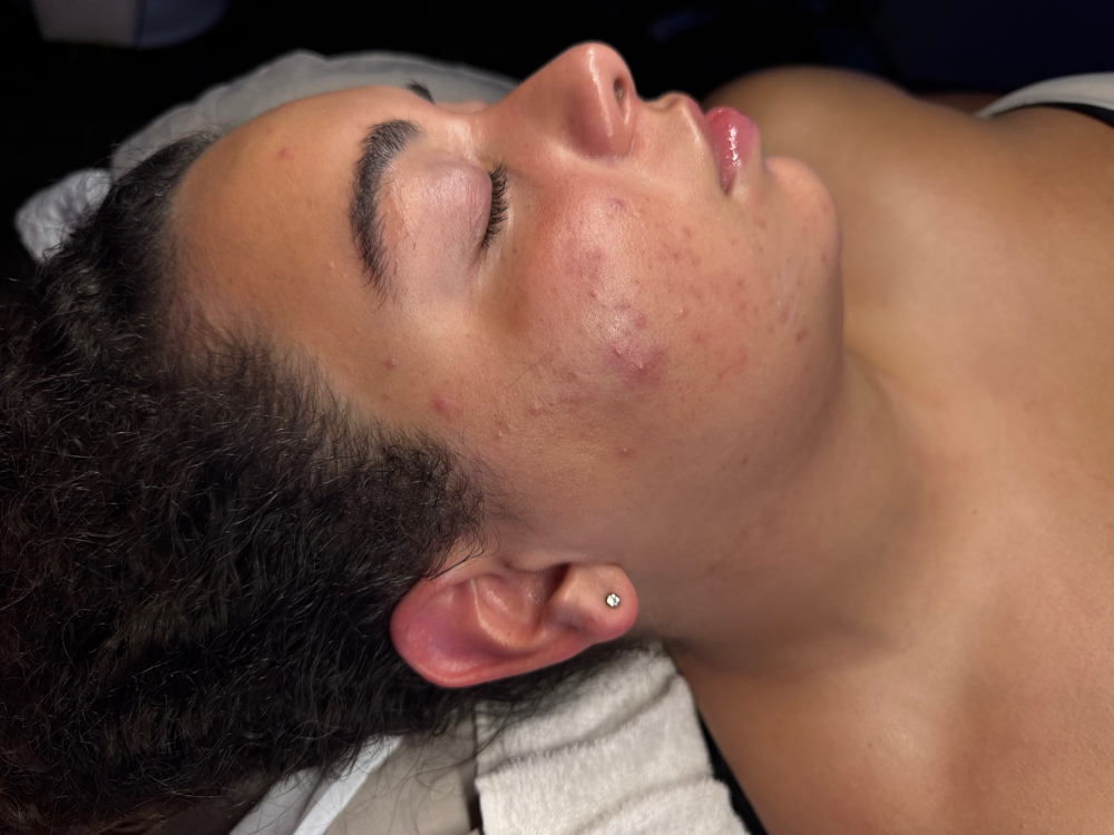 Teen Skin Tune-Up🧴