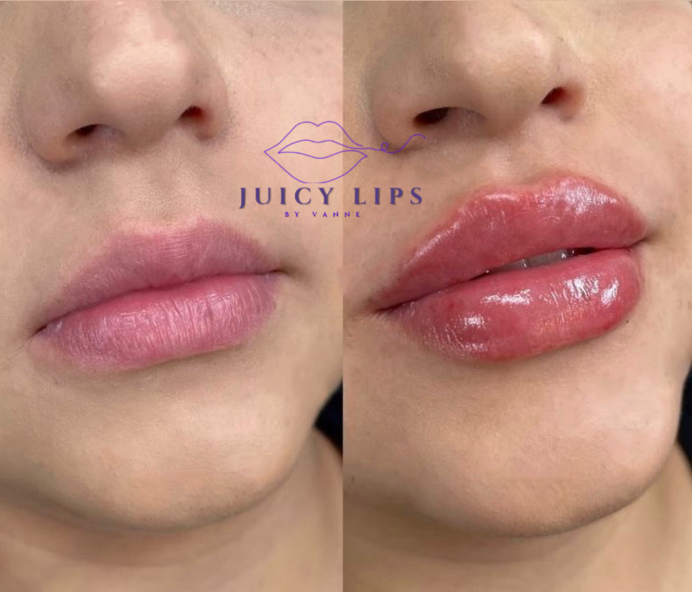 Lip Filler 2ML Without Needle at Dfwbrowsbyvannemorales.com in Fort Worth, TX