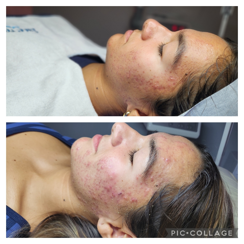 Acne Peel