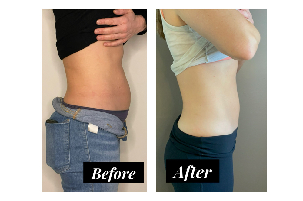 EmSculpt Neo Consultation