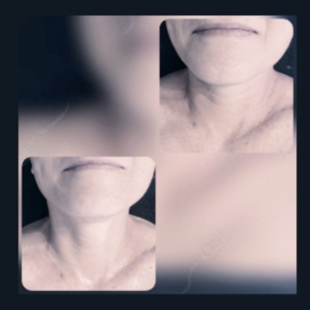 Neck Treatment Ultra Lift at Aqua One Skin Clinic in Jasper, IN