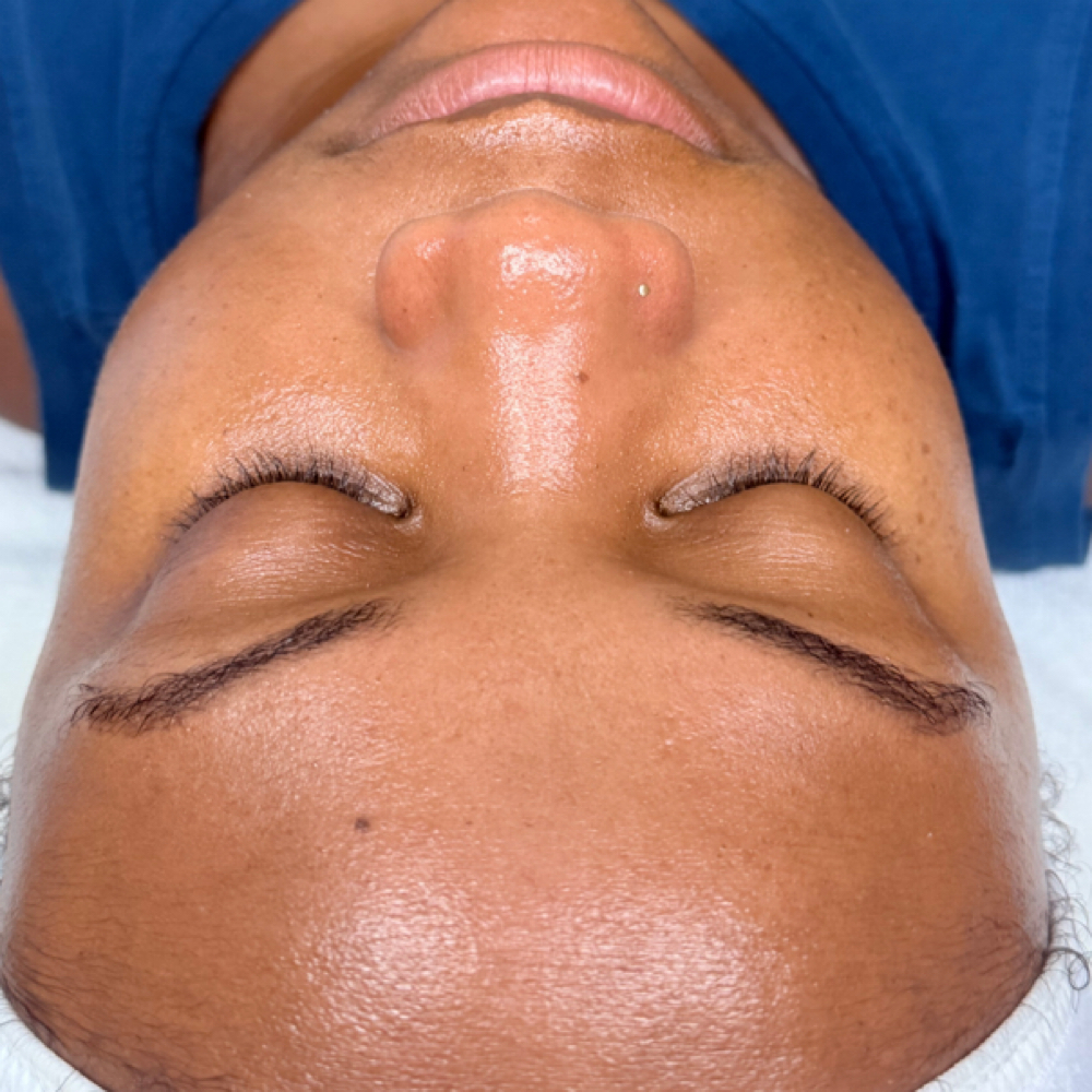 Rêvelite 4C Brightening Correction at Rêvelite Aesthetics in Temecula, CA