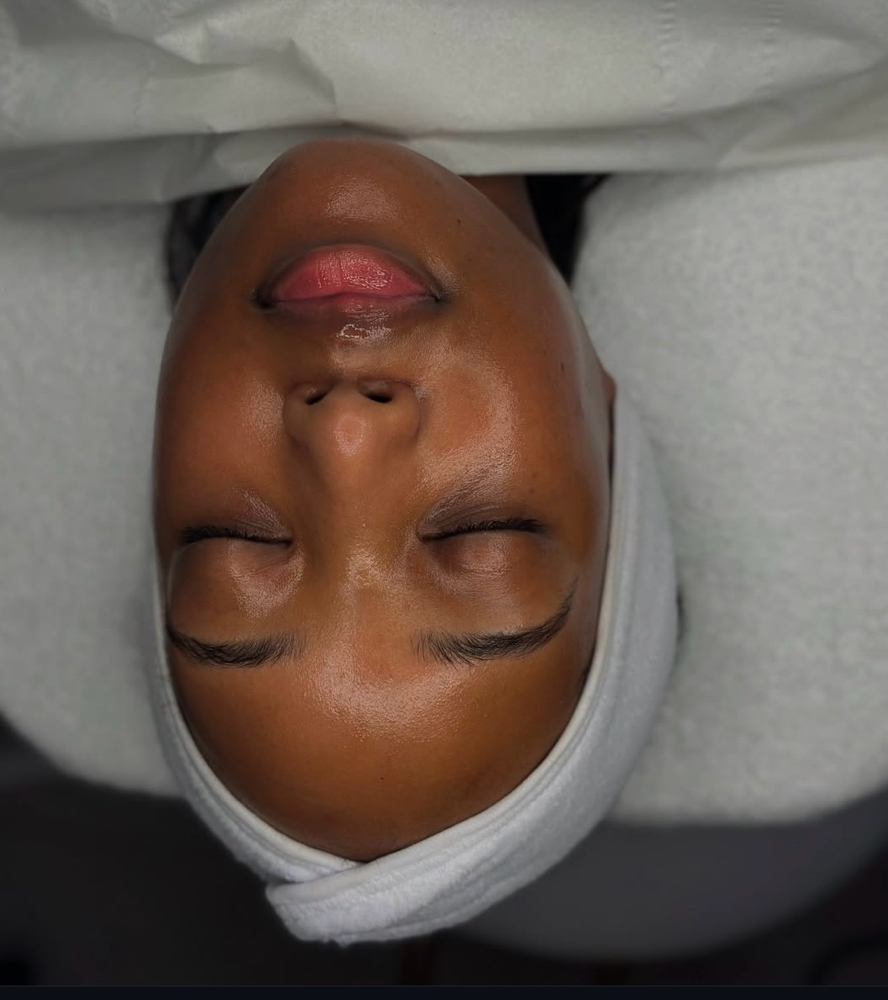 Chemical Peel Facial