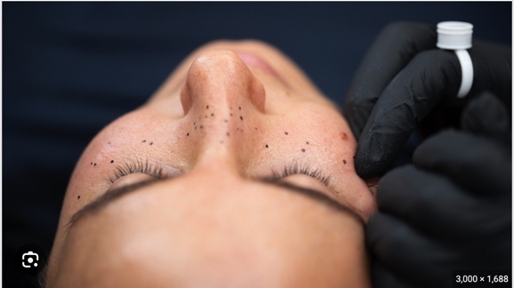 Freckle Tattoo