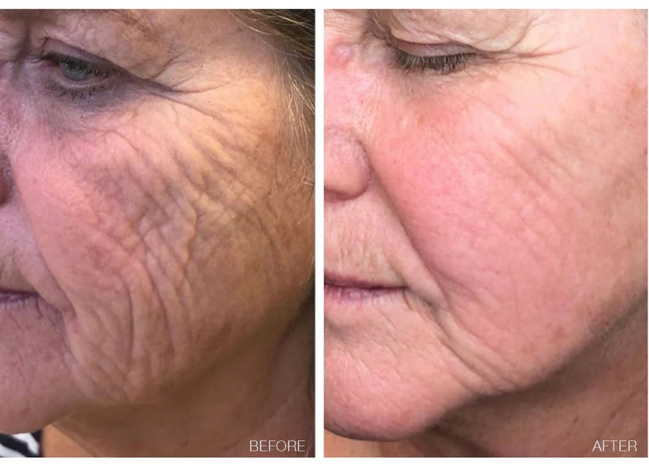 BT Titan Microexfoliation Treatment