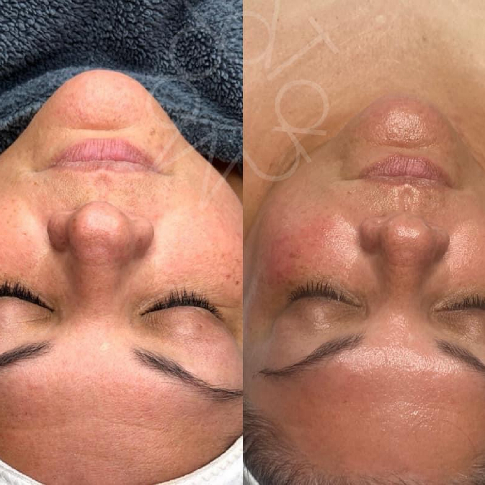 Hydrafacial at Lisa’s Lil Spa Room in Sioux Falls, SD