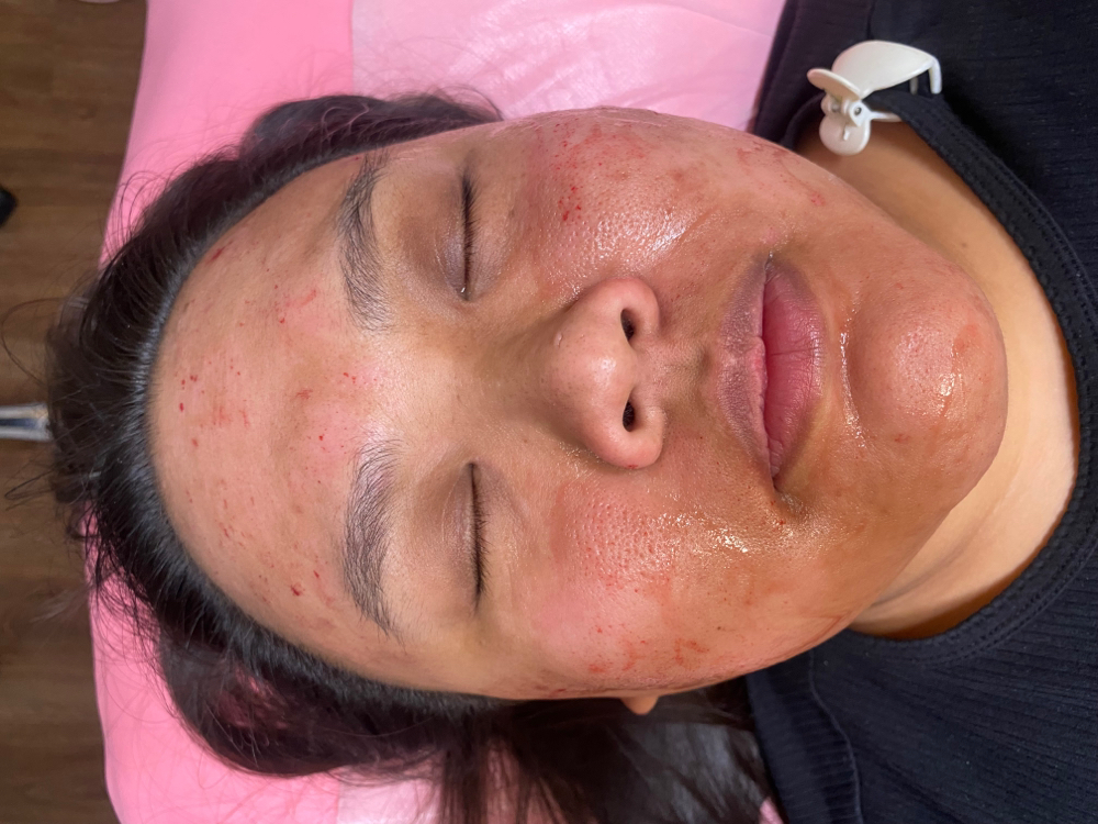 Microneedling at Glow with Pho in Wilmington, MA