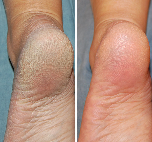 Callus Care