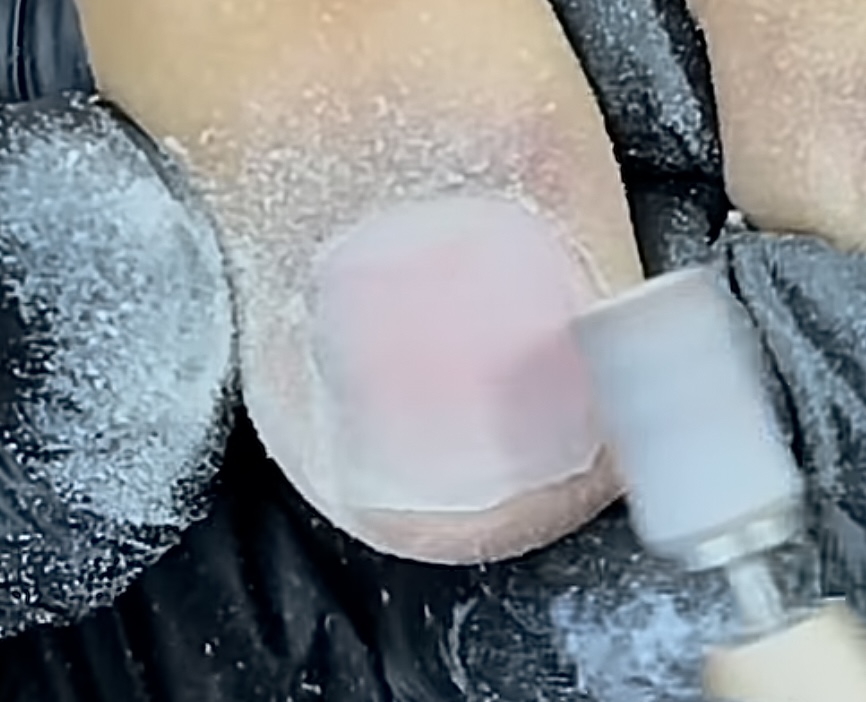 Toe Removal