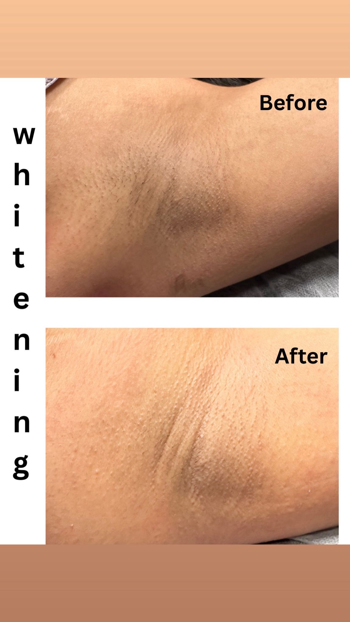 Skin Whitening at Windys Beauty Studio LLC in Virginia Beach, VA