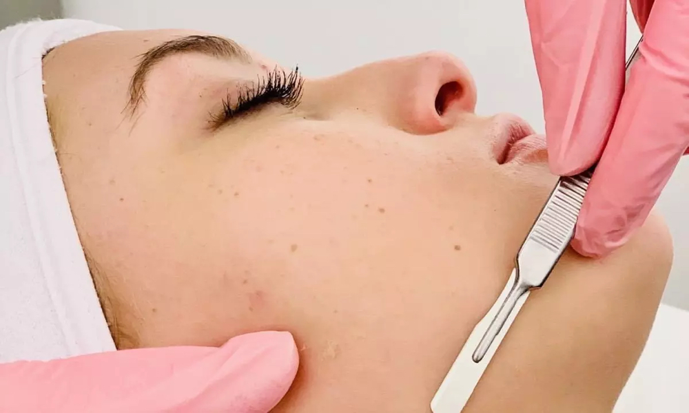 Dermaplaning