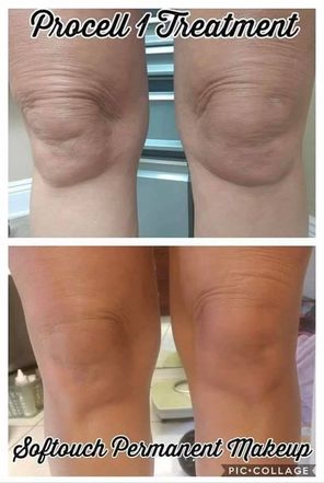 Procell Knees ($150 per knee)