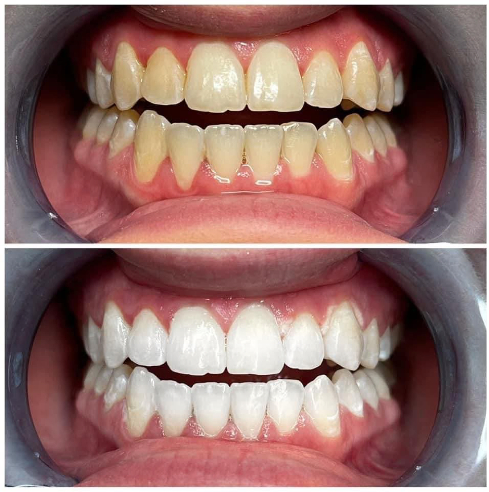 Teeth Whitening at TANW/KII in Waterville, ME