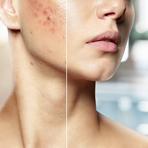 Peeling químico acné
