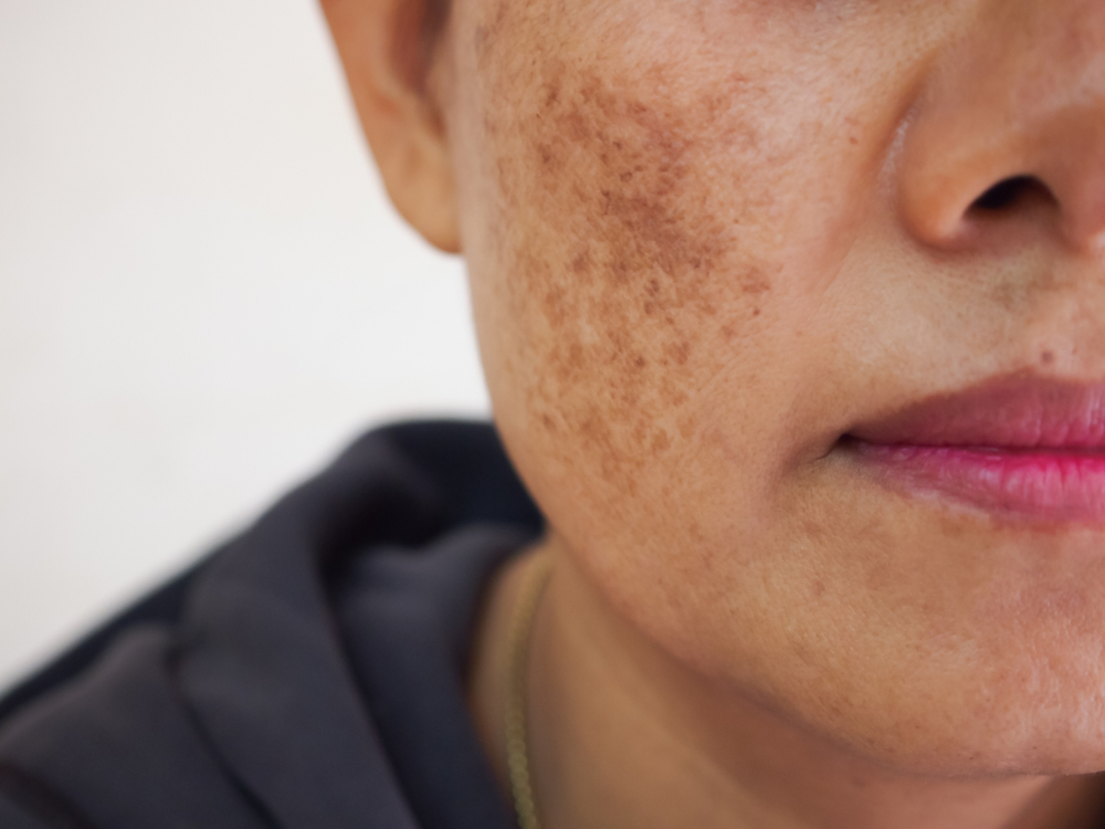 ADVANCED MELASMA CORRECTION 10-PACK at Star Spa Lash & Brow By: Evelyn Esthetician in Oakland, NJ