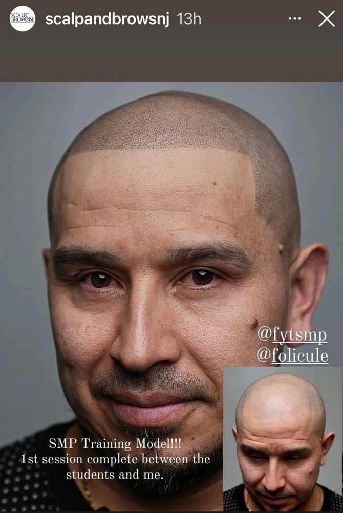 Scalp Micropigmentation Touch-Up