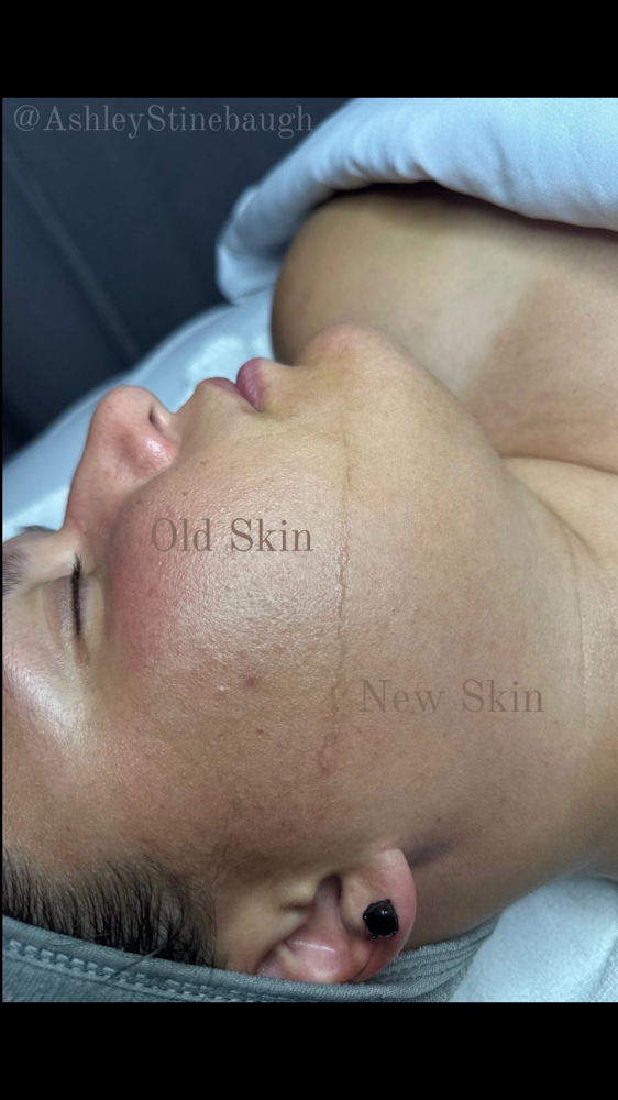 Dermaplaning Add On