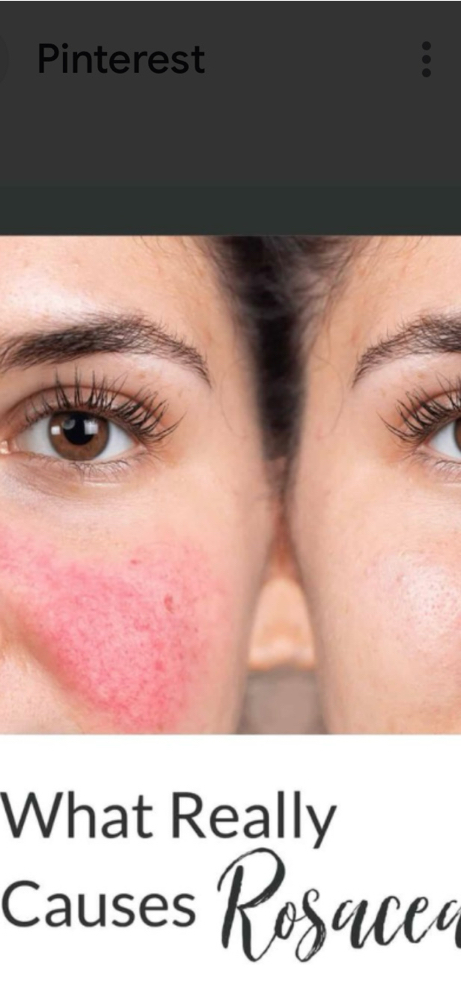 ROSACEA CALMING FACIAL