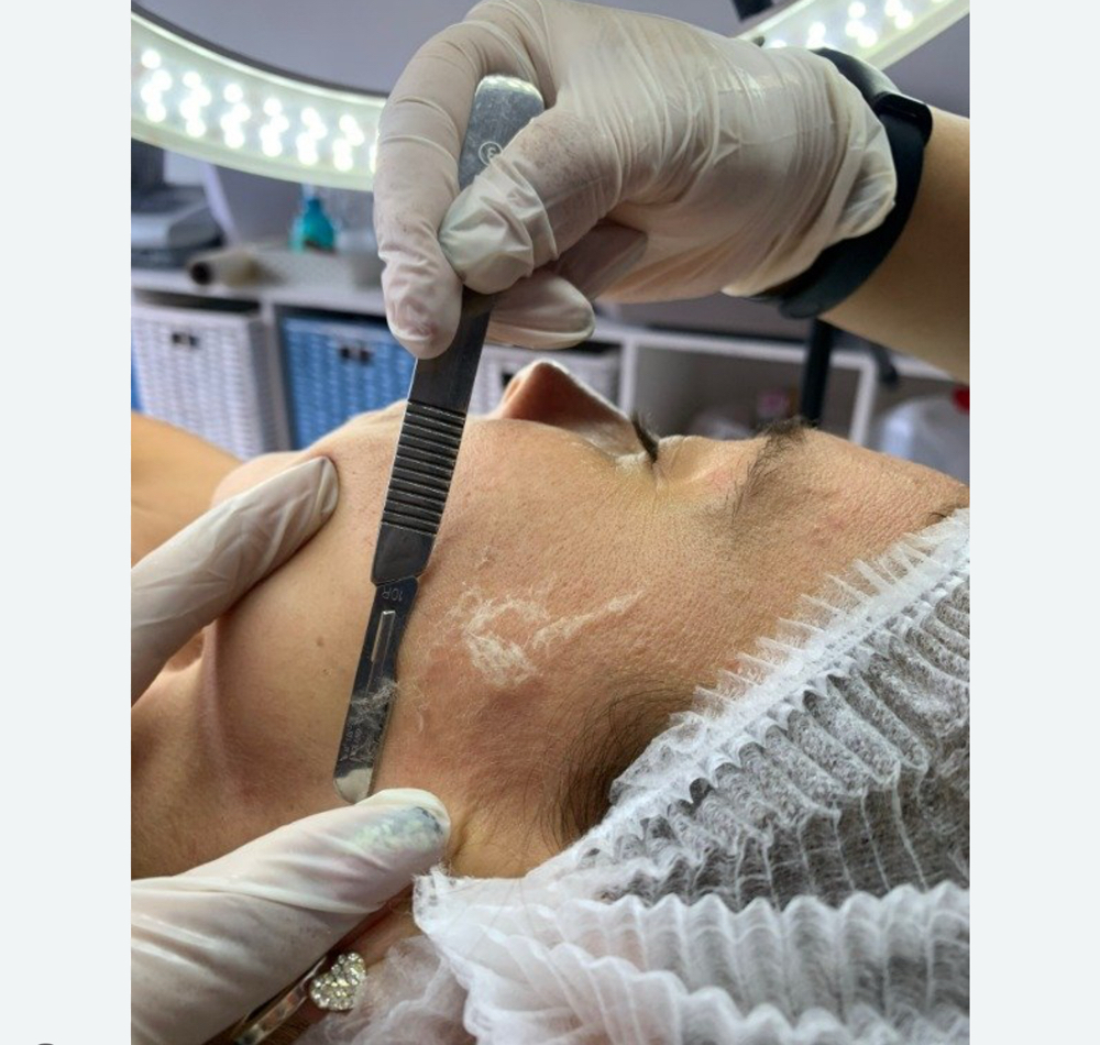 Dermaplaning at Dolls skin in Waukegan, IL