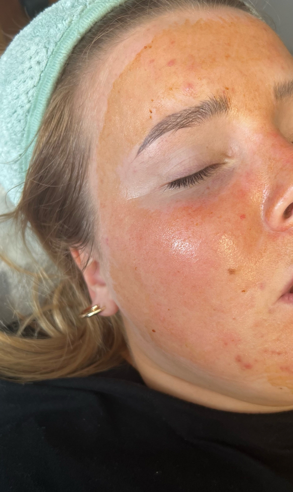 Enzyme Facial