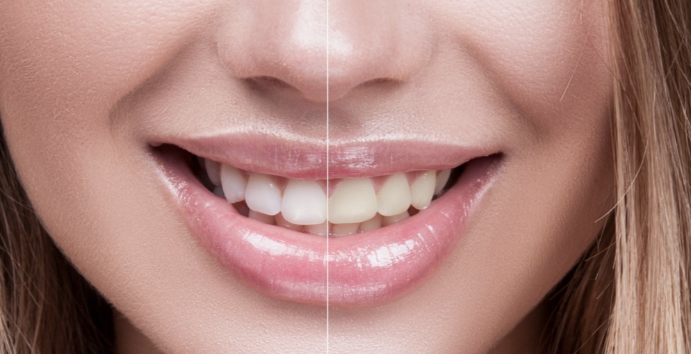 Teeth Whitening