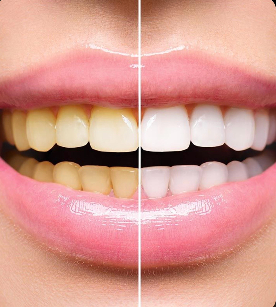 Touch Up Whitening